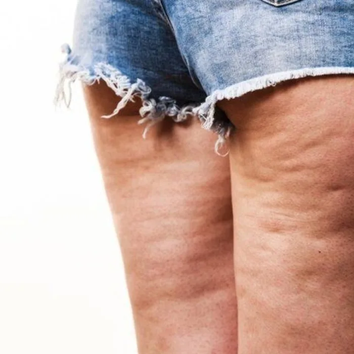 Celulitis