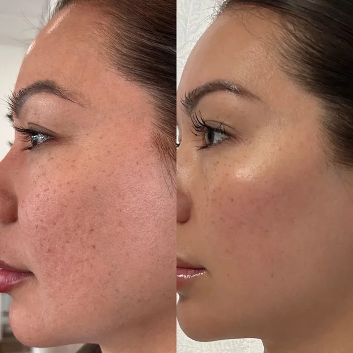 Hollywood Peel