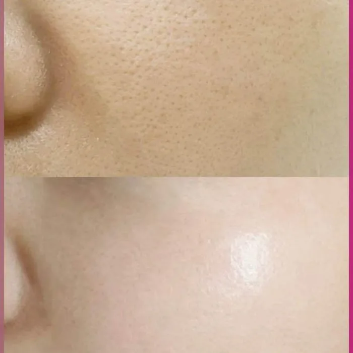 Melasma