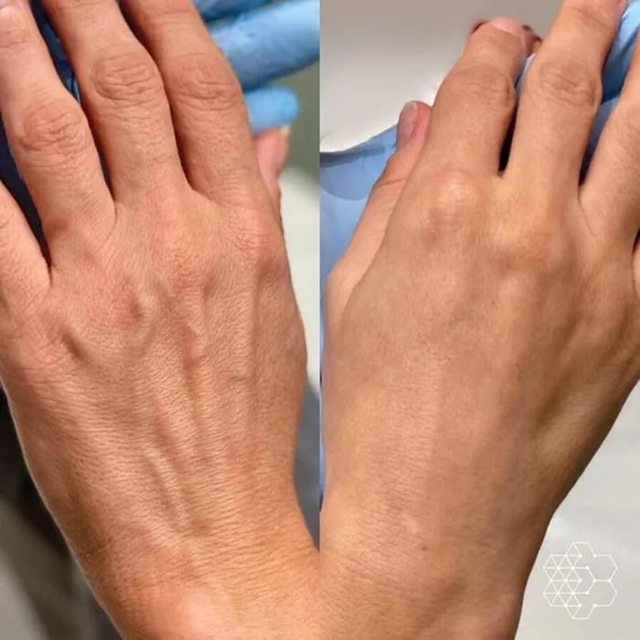 Plasma Fibrolast
