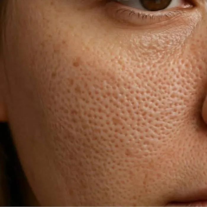 Thulium Laser